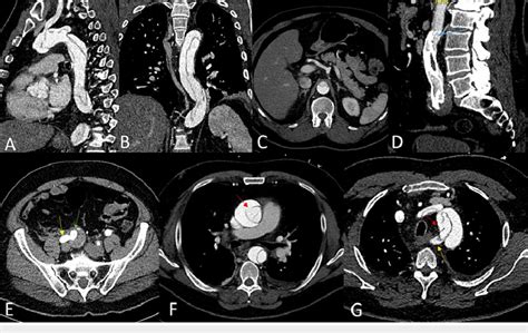 Postoperative Computed Tomography Ct Imaging An Acute Aortic