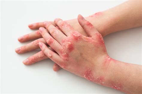 Dystrophic Epidermolysis Bullosa Deb