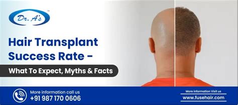 Hair Transplant Success Rate What To Expect Myths And Facts