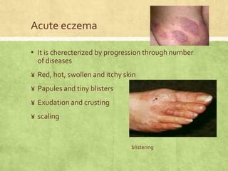 Discoid Eczema: Symptoms, Causes, Diagnosis, Treatment, And, 48% OFF