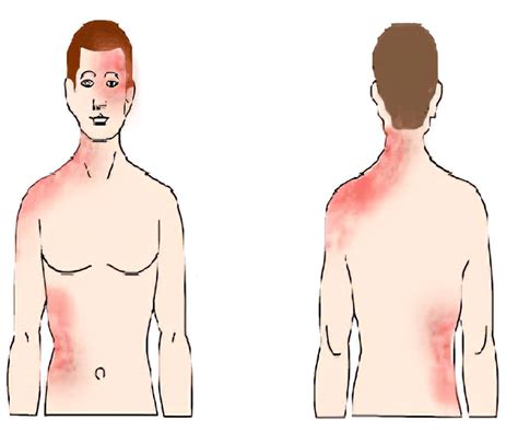 Postherpetic Neuralgia Symptoms Causes Treatment 55 OFF