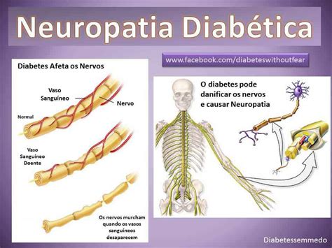 Neuropatia Diab Tica O Que Causas Sintomas E Tratamentos