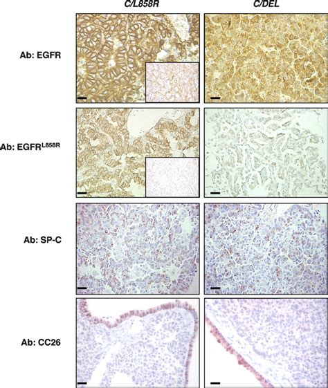 Lung Adenocarcinomas Induced In Mice By Mutant Egf Receptors Foundin Human Lung Cancers