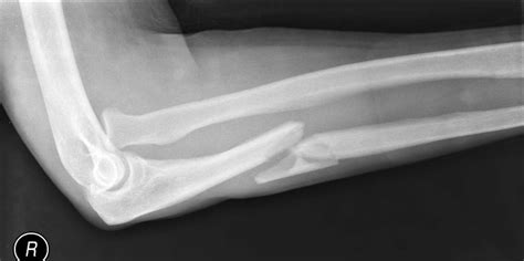 Monteggia Fracture Dislocation Type 1 Image