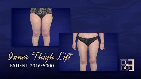 Inner Thigh Lift Before And After Youtube