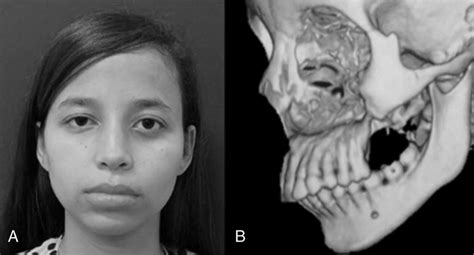 A The Frontal View Of The Patient In The Postoperative Period Of 2 Yr Download Scientific