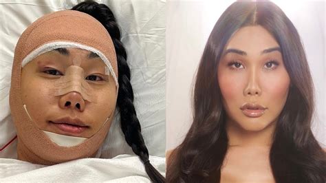 My Facial Feminization Surgery Story Gia Gunn Youtube