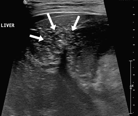 E Transverse Sonogram Demonstrates A Heterogeneous Appearance Of The