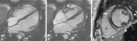 Cardiovascular Magnetic Resonance Of Patient A Ab Show The 4 Chamber