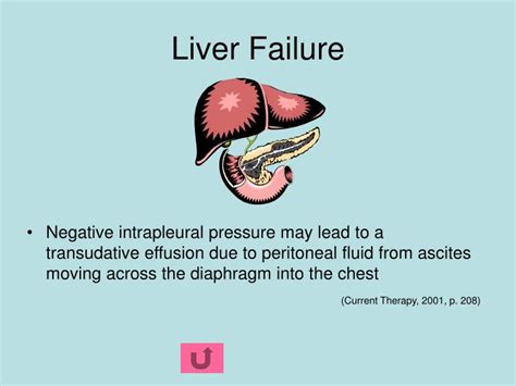 Ppt Pleural Effusions Powerpoint Presentation Id 224571