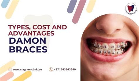 Damon Braces Type Cost And Advantages Of Damon Braces