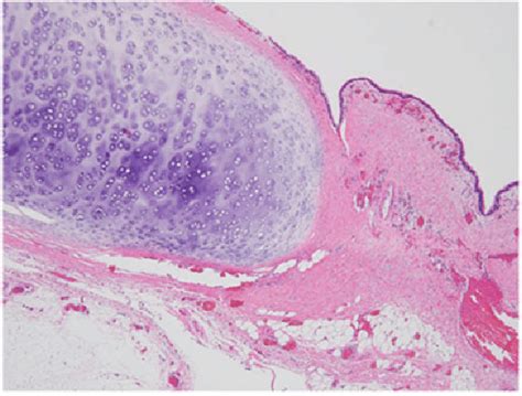 Microscopic View Of Resected Bronchogenic Cyst Showing Ciliated