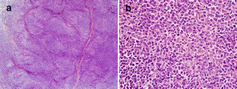 Kras Mutation In Secondary Malignant Histiocytosis Arising From Low