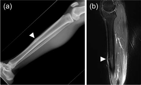 Medial Tibial Stress Fracture