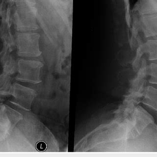 Preoperative flexion and extension of lumbar spine (Left image) Lateral... | Download Scientific ...