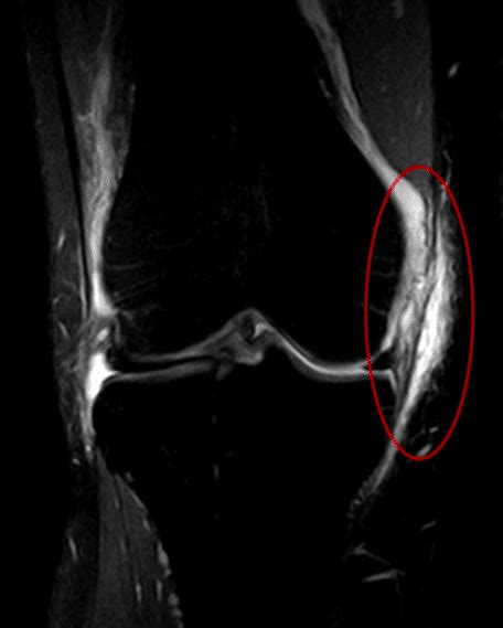 Medial Collateral Ligament Mri