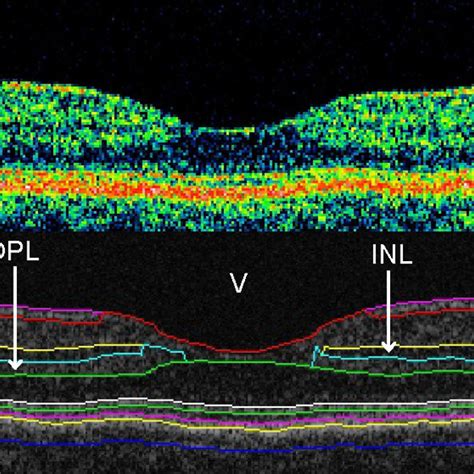 Time Domain Oct Scan Of A Healthy Macula A And The Corresponding