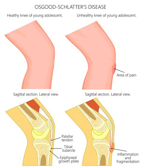 Osgood Schlatters Disease