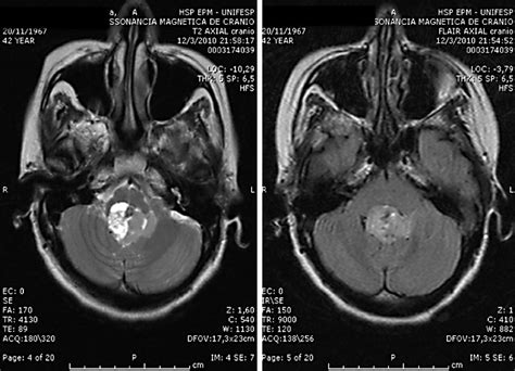 T2 And Flair Sequences Showing A Brain Stem Tumor Invading The Fourth