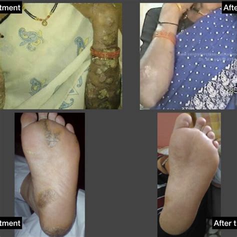 Case 1 before and after treatment of erythrodermic psoriasis | Download ...