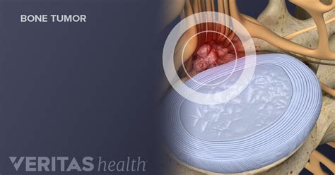 Types of Spinal Tumors