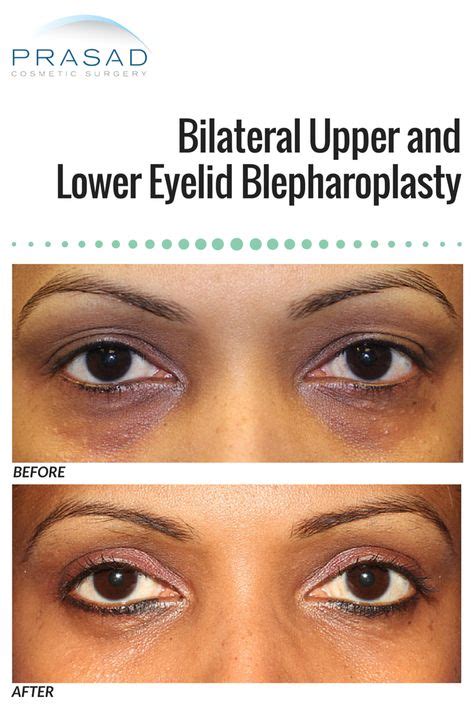 Before And After Bilateral Upper And Lower Eyelid Blepharoplasty With