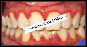 Gingivitis Code What You Must Do