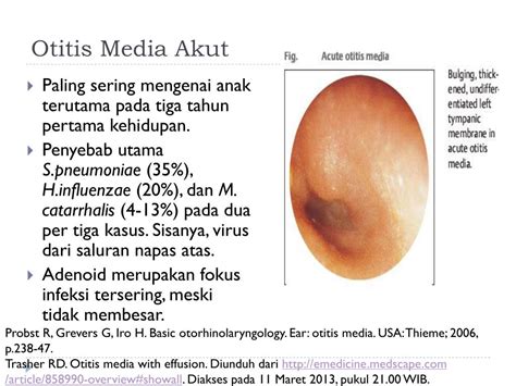 Best Antibiotics For Otitis Media