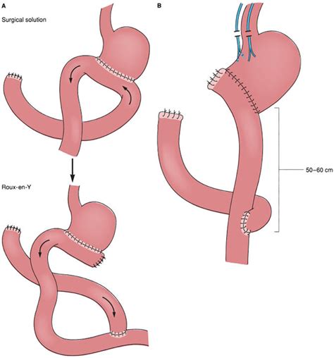 Roux En Y Gastrojejunostomy For Stomach Cancer