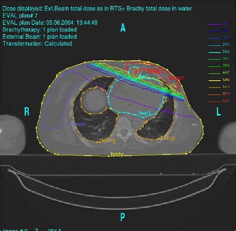 Figure 1 From HDR Brachytherapy Combined With 3D Conformal Versus IMRT