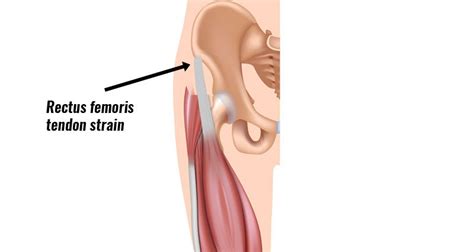 Rectus Femoris Tendon Strain Symptoms Causes Treatment Rehab