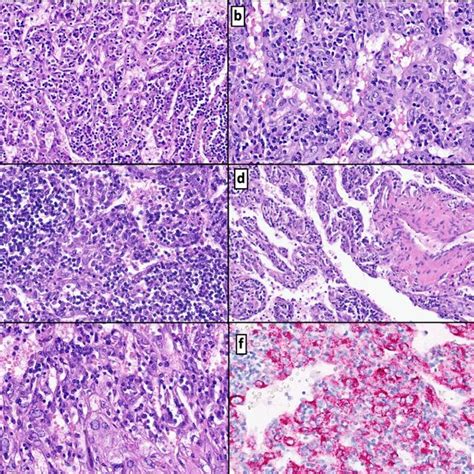 Core Needle Biopsy Cnb A Mesenchymal Spindled Cell Proliferation Download Scientific Diagram