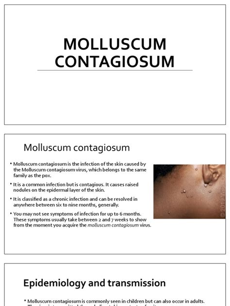 Molluscum Contagiosum Pdf Clinical Medicine Cutaneous Conditions