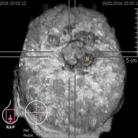 Bilateral Galactocele | Eurorad