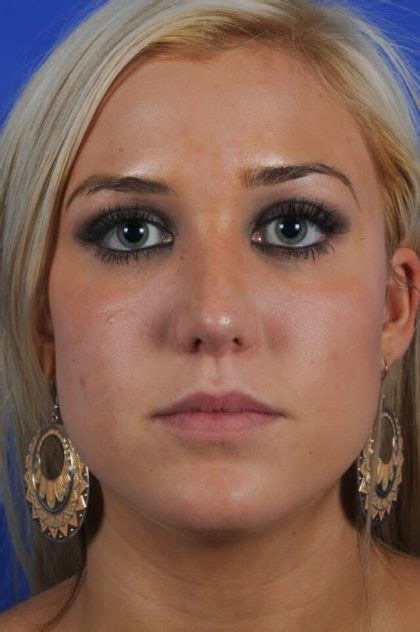 Patient Primary Rhinoplasty Before And After Photos Englewood