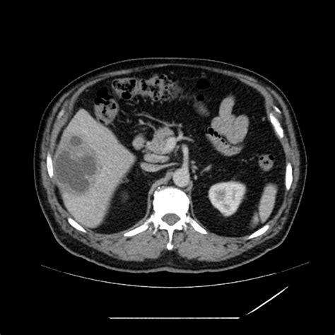 Amoebic Hepatic Abscess Radiology Reference Article