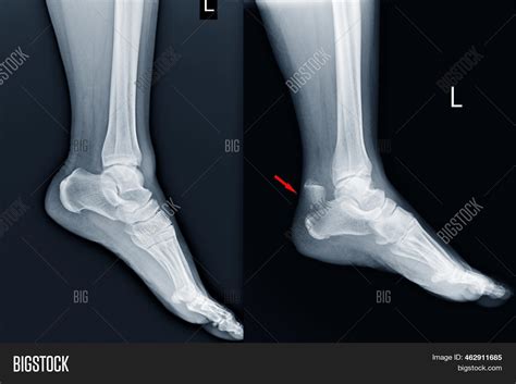 Film Ankle X-ray Image & Photo (Free Trial) | Bigstock