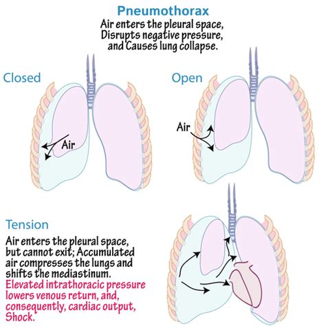 Pneumothorax Flashcards Quizlet