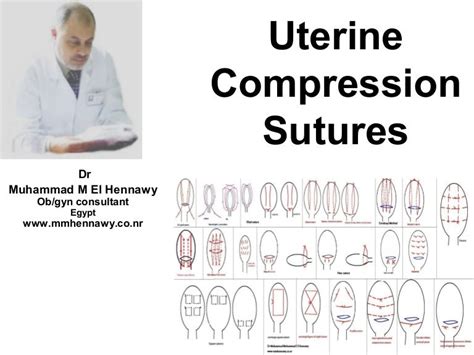 Uterine Compression Sutures