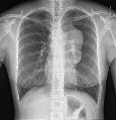 Chest Radiograph Postero Anterior View Shows A Large Mediastinal Mass