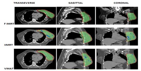 Dose Distribution Of F Imrt I Imrt And Vmat Respectively At Three