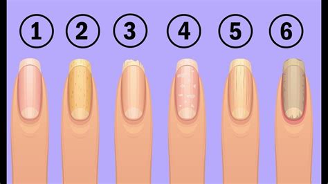 8 Health Warnings Your Fingernails May Be Sending Nail Symptoms And