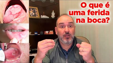 O QUE É UMA FERIDA NA BOCA Como proceder YouTube