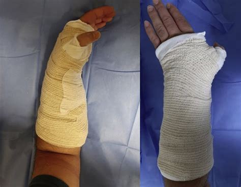 Clinical Outcomes Comparison Of Distal Radius Fractures Between Two