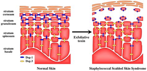 Staphylococcal Scalded Skin Syndrome Histology