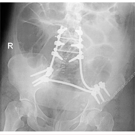 Reconstruction Using Transpedicular And Iliac Screws After Total Download Scientific Diagram