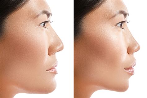 Best Asian Rhinoplasty In Miami Fl Dr Anthony Bared