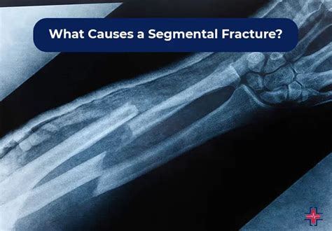 Segmental Fracture Symptoms Causes And Treatment Er Of Mesquite