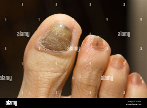 Ridged Thick And Discolored Toenail With Fungus A Side Effect Caused