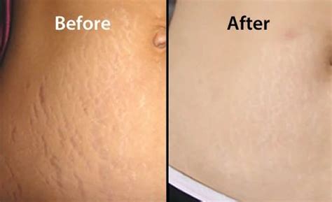 Stretch Marks Treatment in Chennai | ID: 16369367130